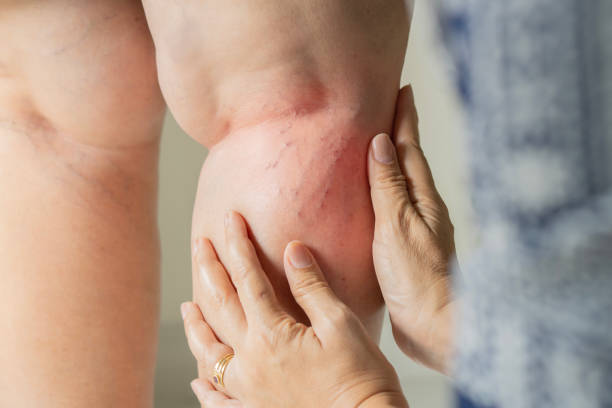 Superficial Thrombophlebitis