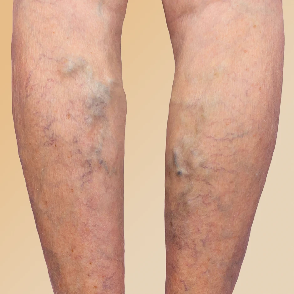 varicose-veins