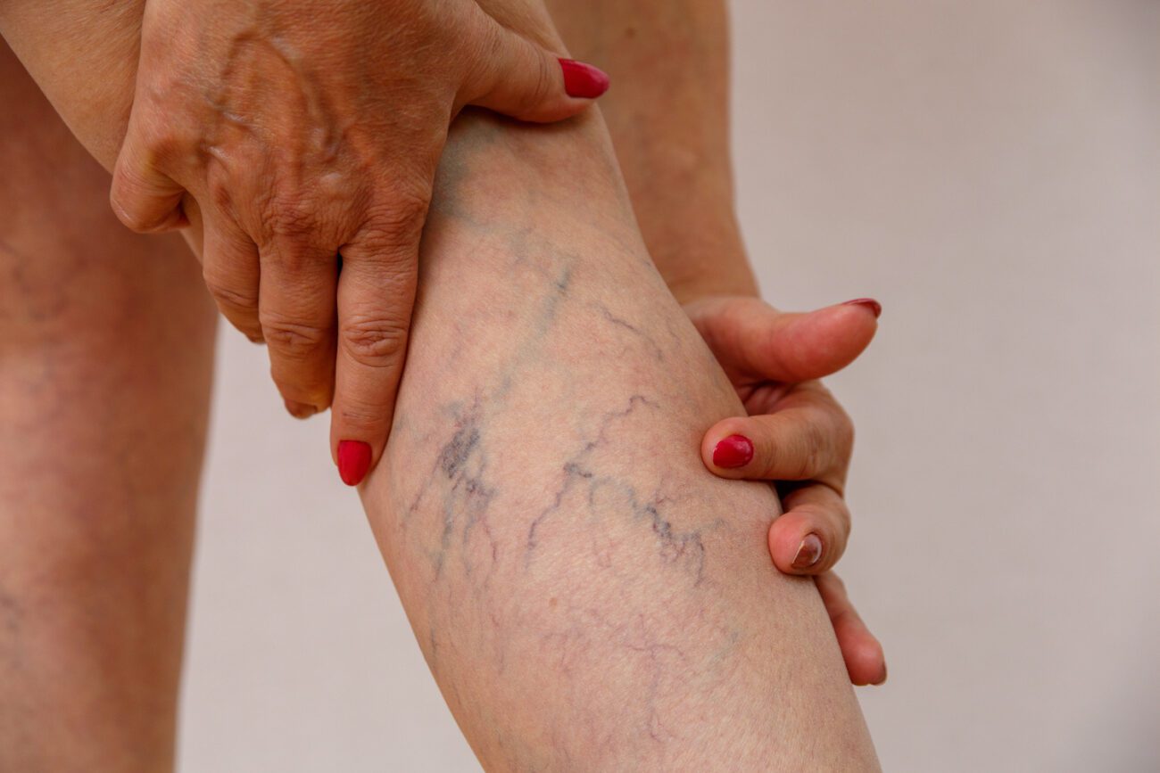 vaticose veins