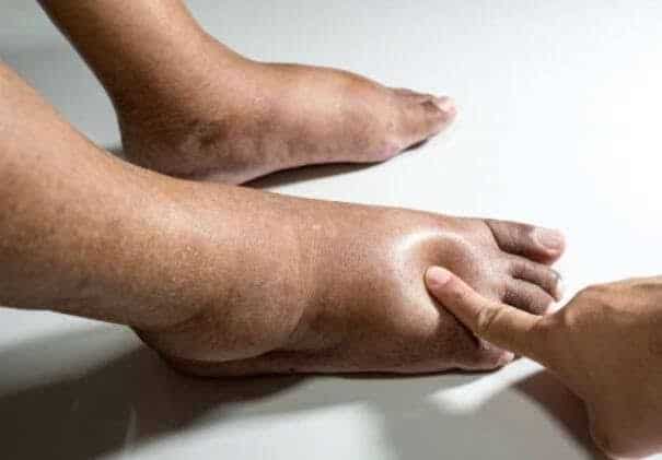 Leg Swelling