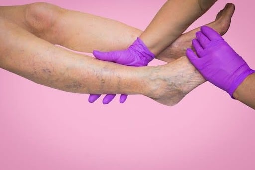 Venous Insufficiency